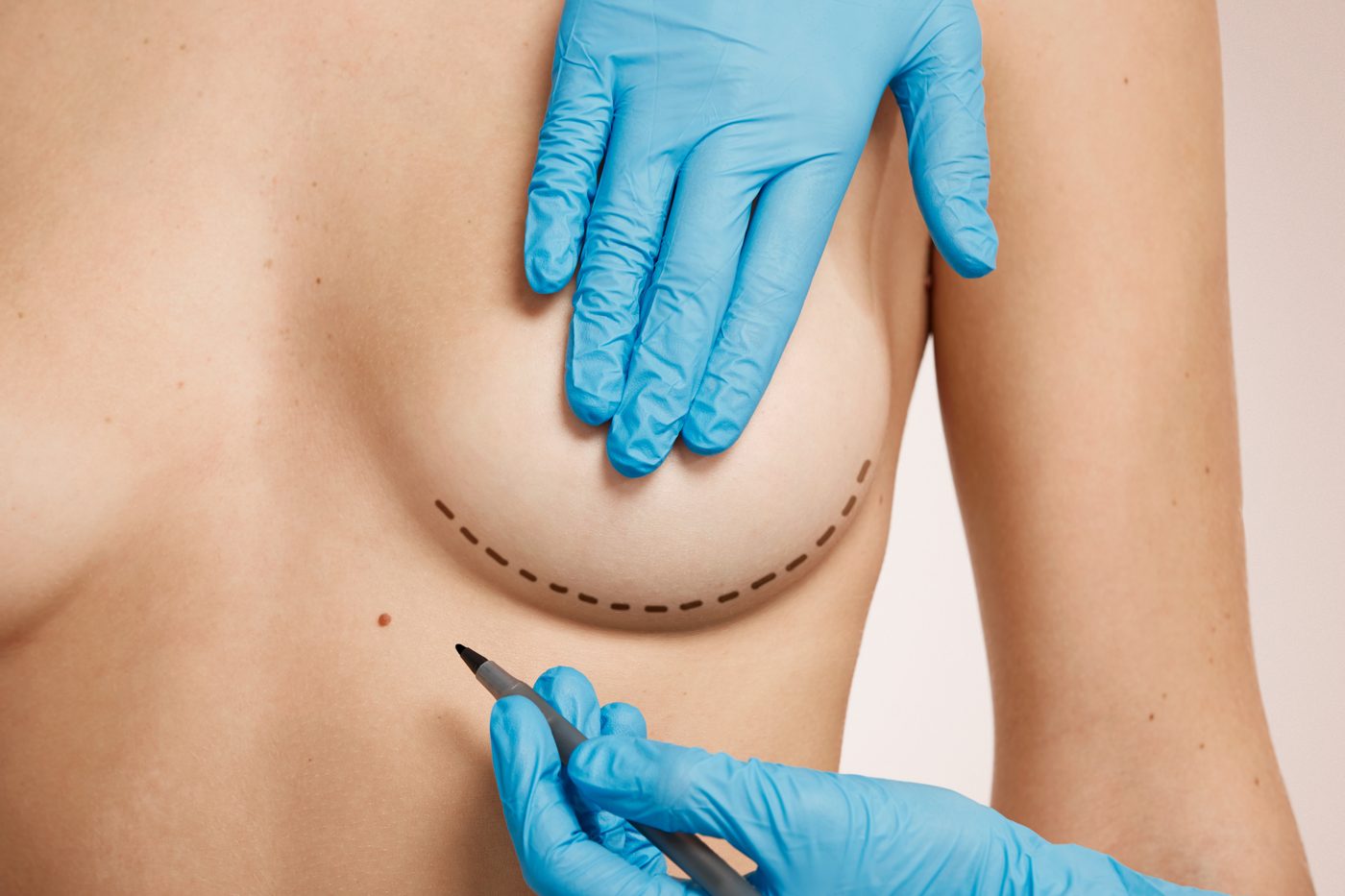 Breast Augmentation Marketing