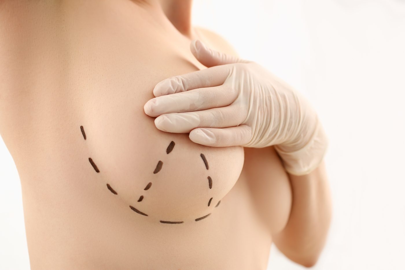 Breast Lift (Mastopexy) Marketing