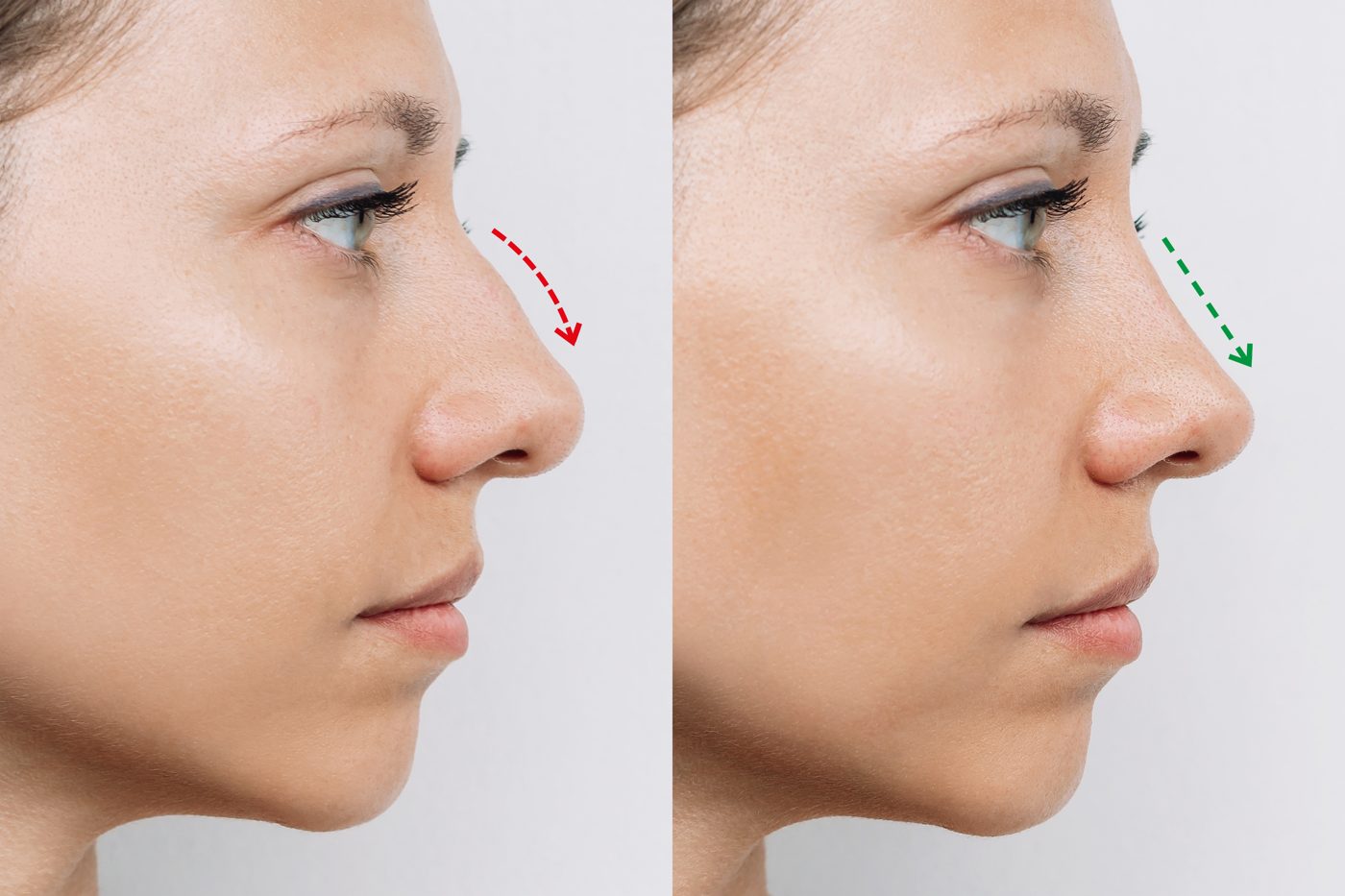 Rhinoplasty Marketing